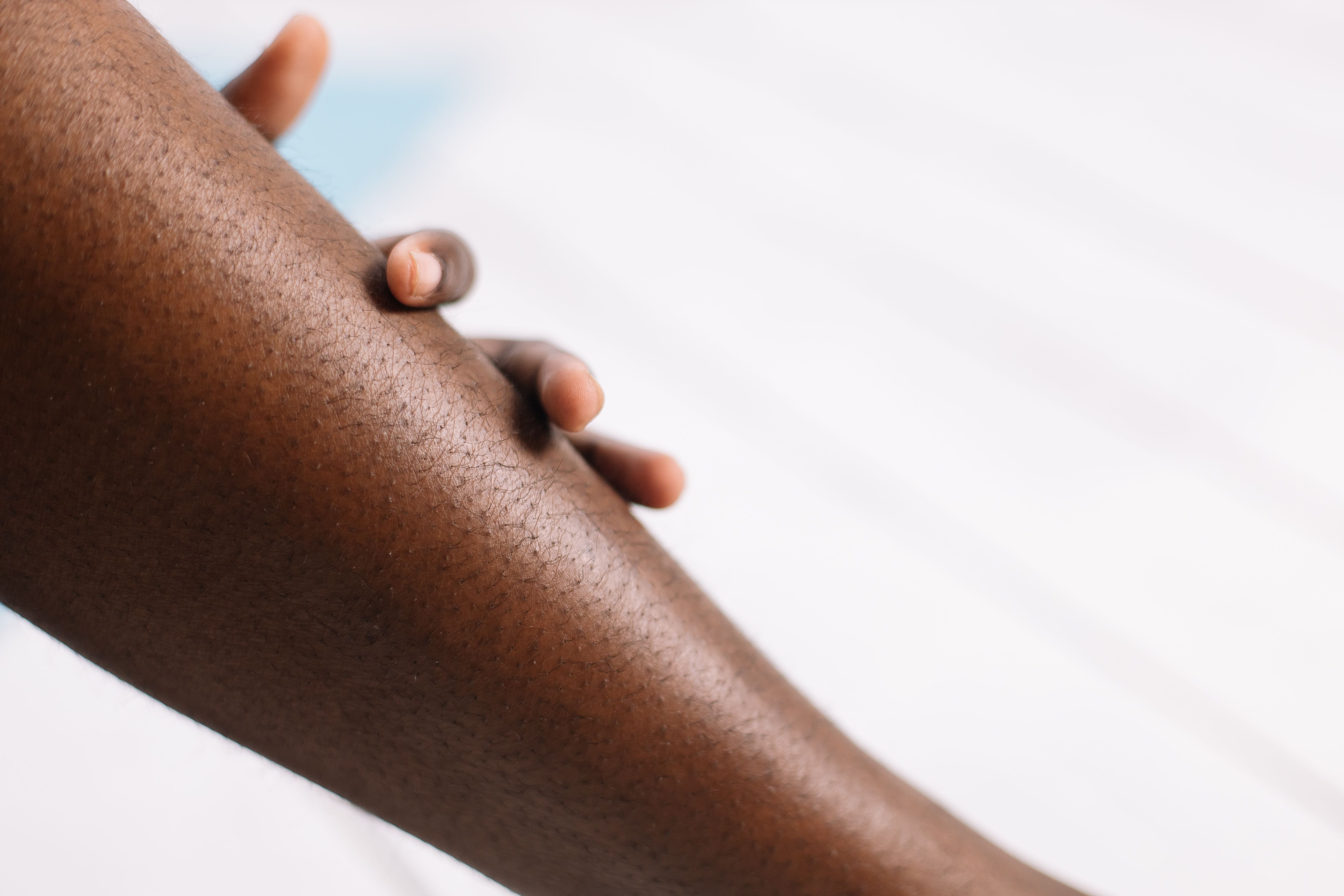 Poster Highlights RFMN’s Promise for Treating Hypertrophic Scars in Darker Skin 