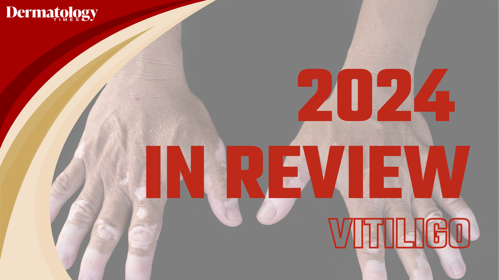 Dermatology Times 2024 In Review: Vitiligo