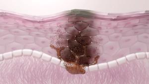 Evidence-Based Best Practices for Melasma Care