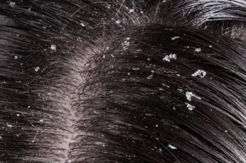 dandruff