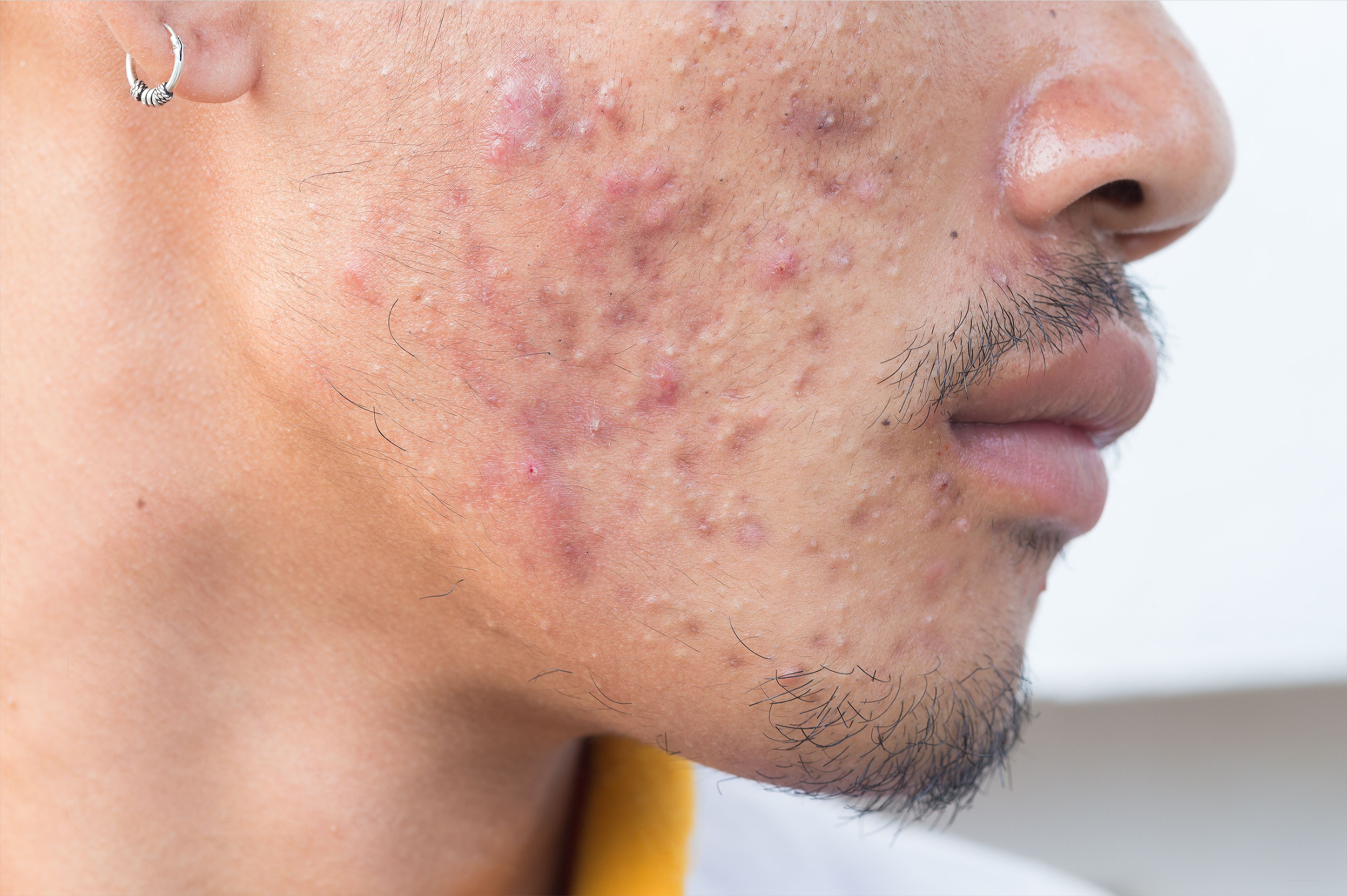 Newly Discovered Antimicrobial Fat Cells May Offer New Treatment Options for Acne