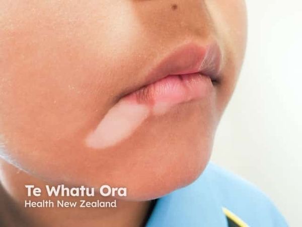 Vitiligo-Like Depigmentation Reported in NHEJ1-Related Radiosensitive SCID