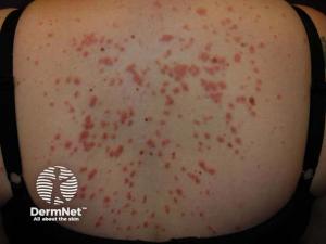 Comparative Analysis Positions Zasocitinib Among Next-Generation TYK2 Inhibitors