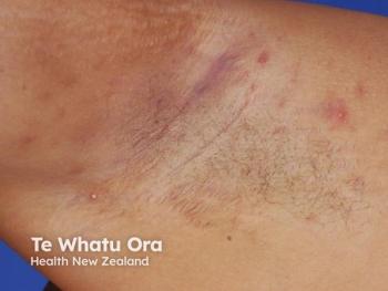 can glutathione cause skin rashes Botanic main image 1