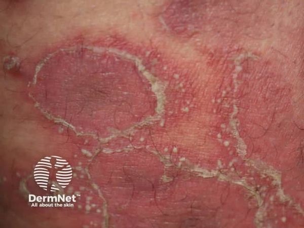 10 Frequently Asked Questions About Generalized Pustular Psoriasis