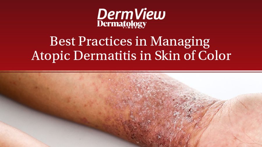 DermView: Best Practices in Managing Atopic Dermatitis in Skin of Color 