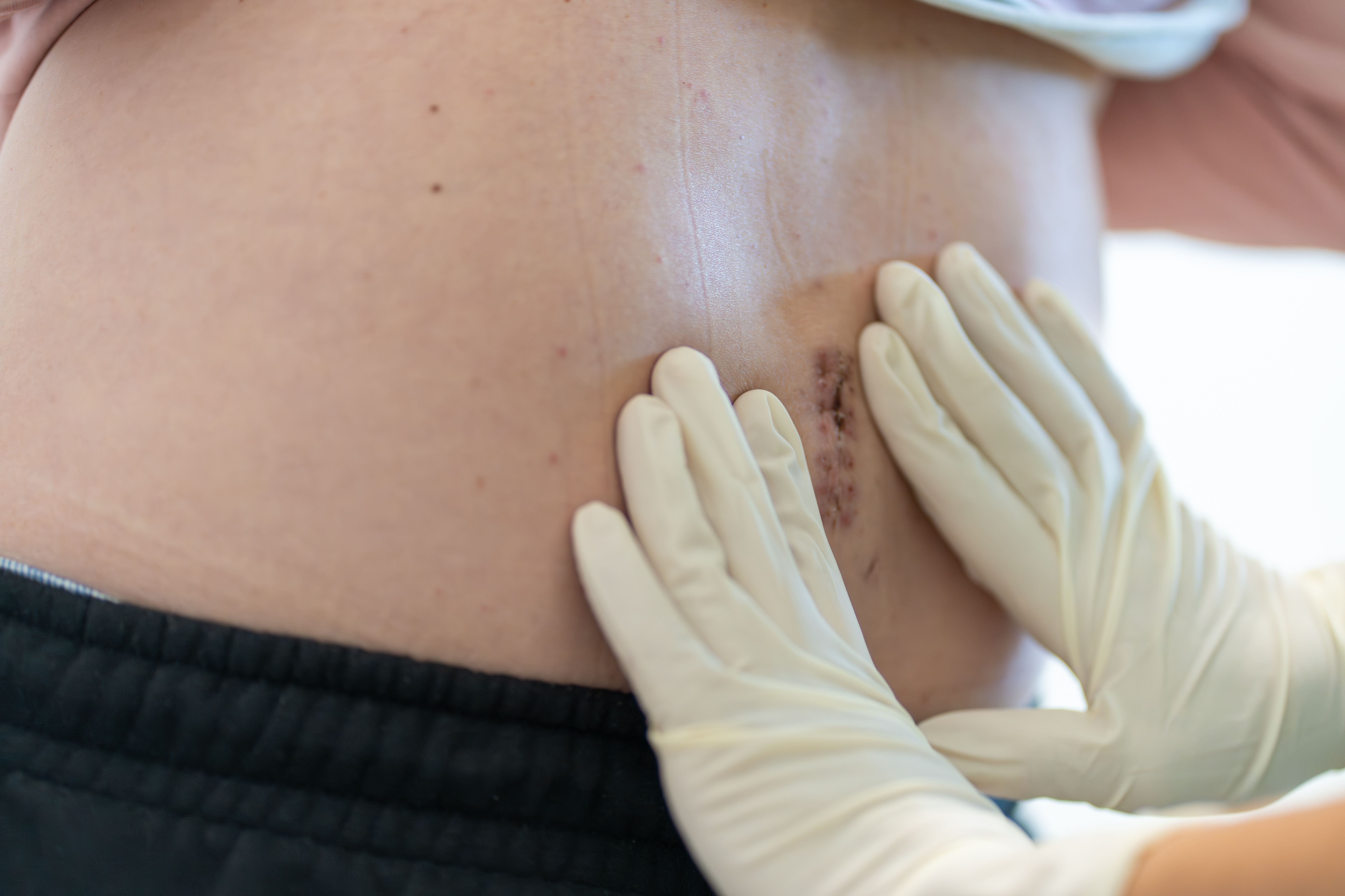 Wound Risks Managing Wound Risks in Patients on TKIs