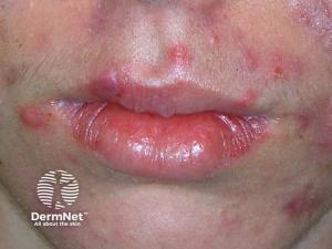 Biologic Therapy Shows Promise for Tough Acne