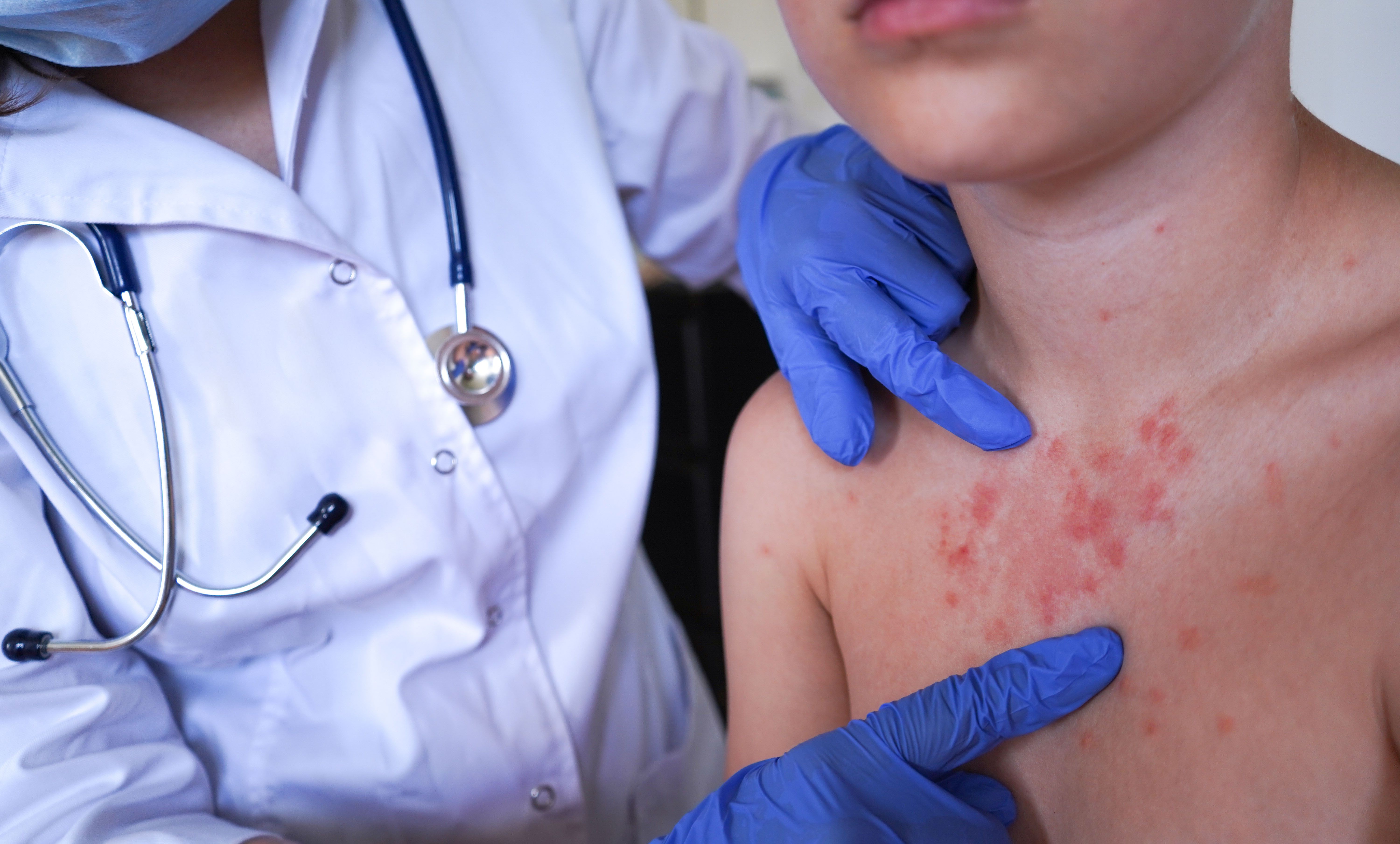Recognizing and Managing Pediatric Summer Skin Eruptions