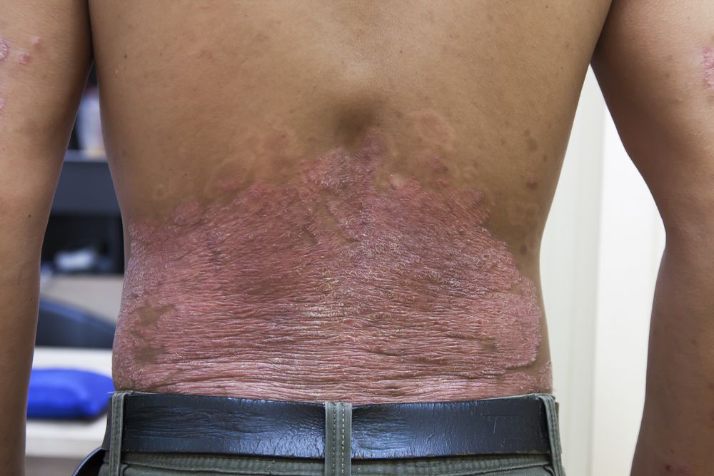 psoriasis black skin treatment