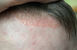 Scalp psoriasis