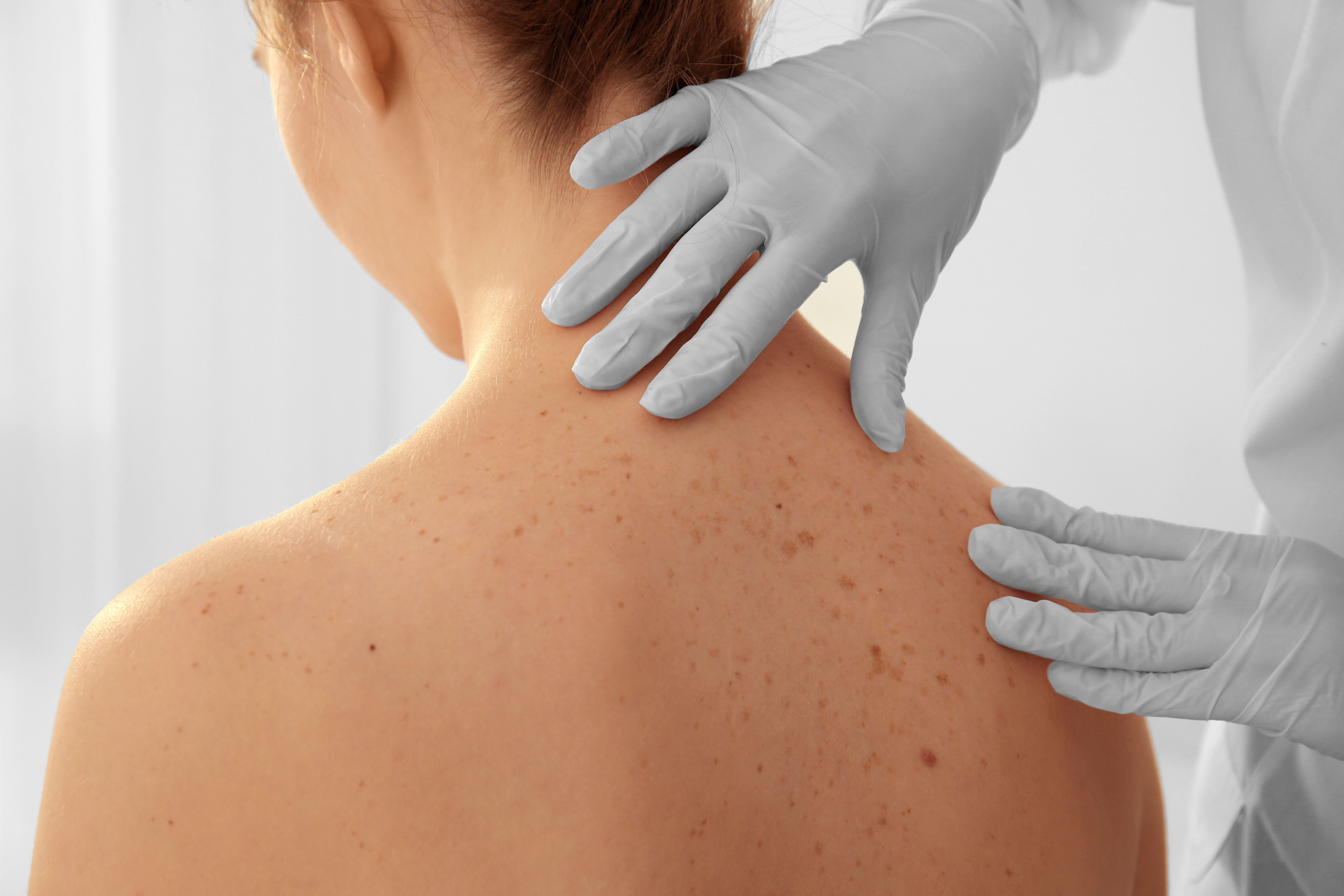 nonmelanoma skin cancer