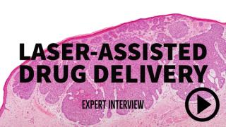 laser-assisted drug delivery