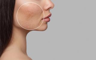 Adolescent Rosacea in Peer-Reviewed Publications and Use of the 2017 National Rosacea Society Updated Guidelines