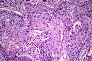 Neoadjuvant Cemiplimab Induces Promising Pathologic Complete Response in CSCC