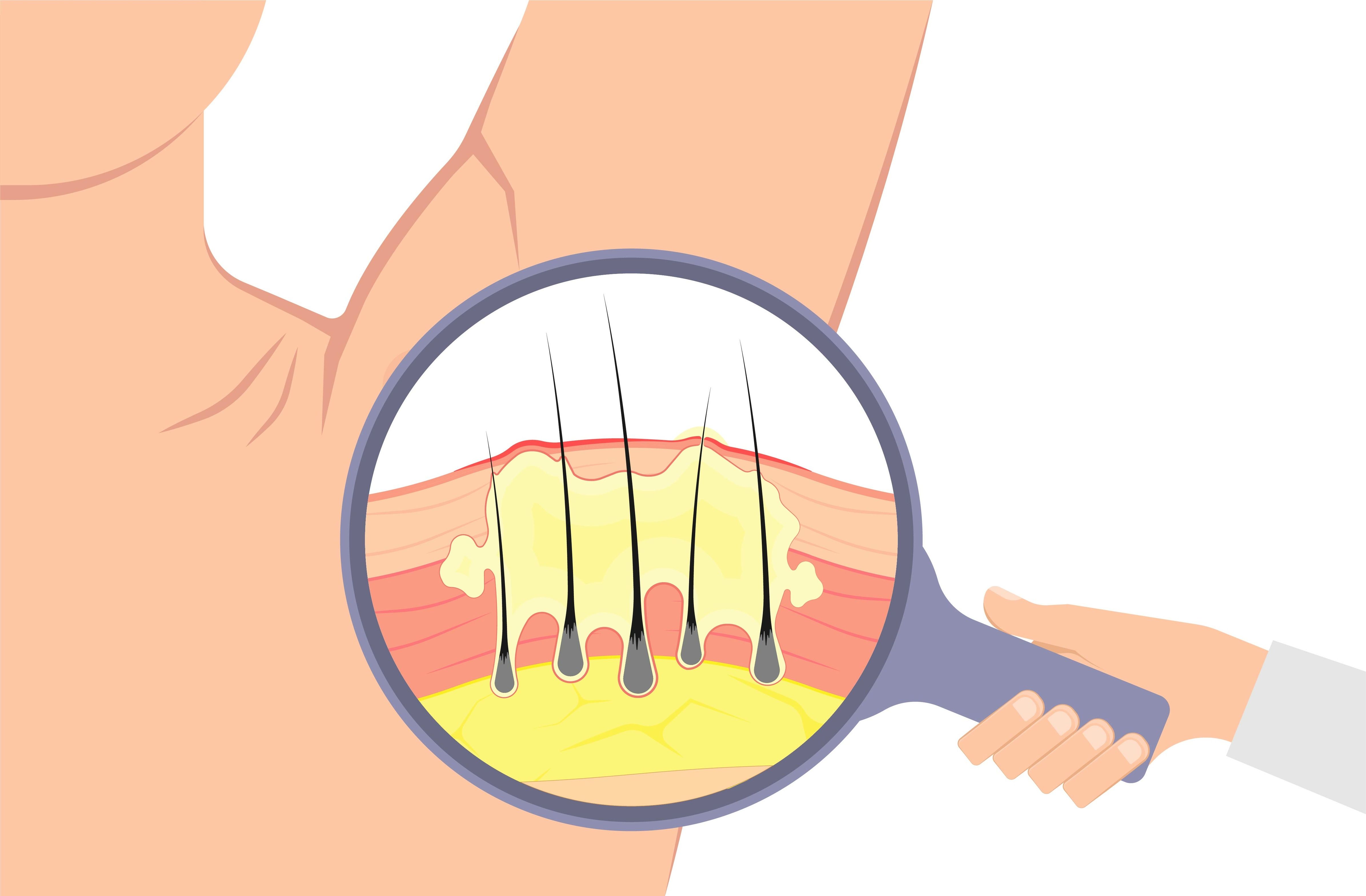 HS Dosing  COSENTYX® (secukinumab)