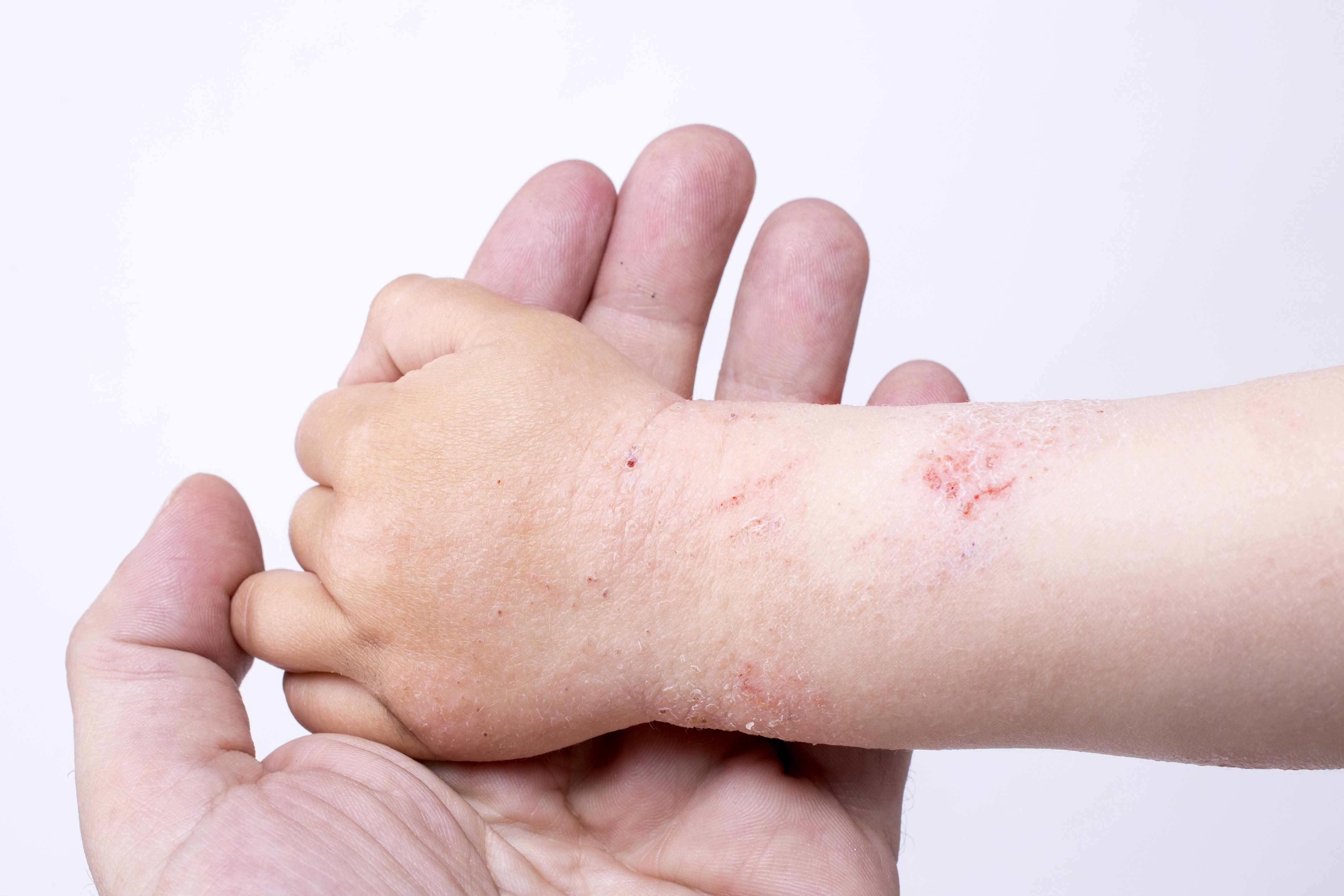 Person holding child's hand which shows red, irritated skin