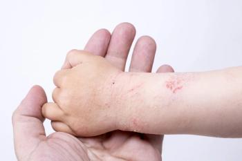Person holding child's hand which shows red, irritated skin