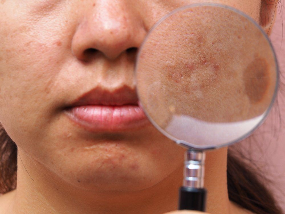 melasma