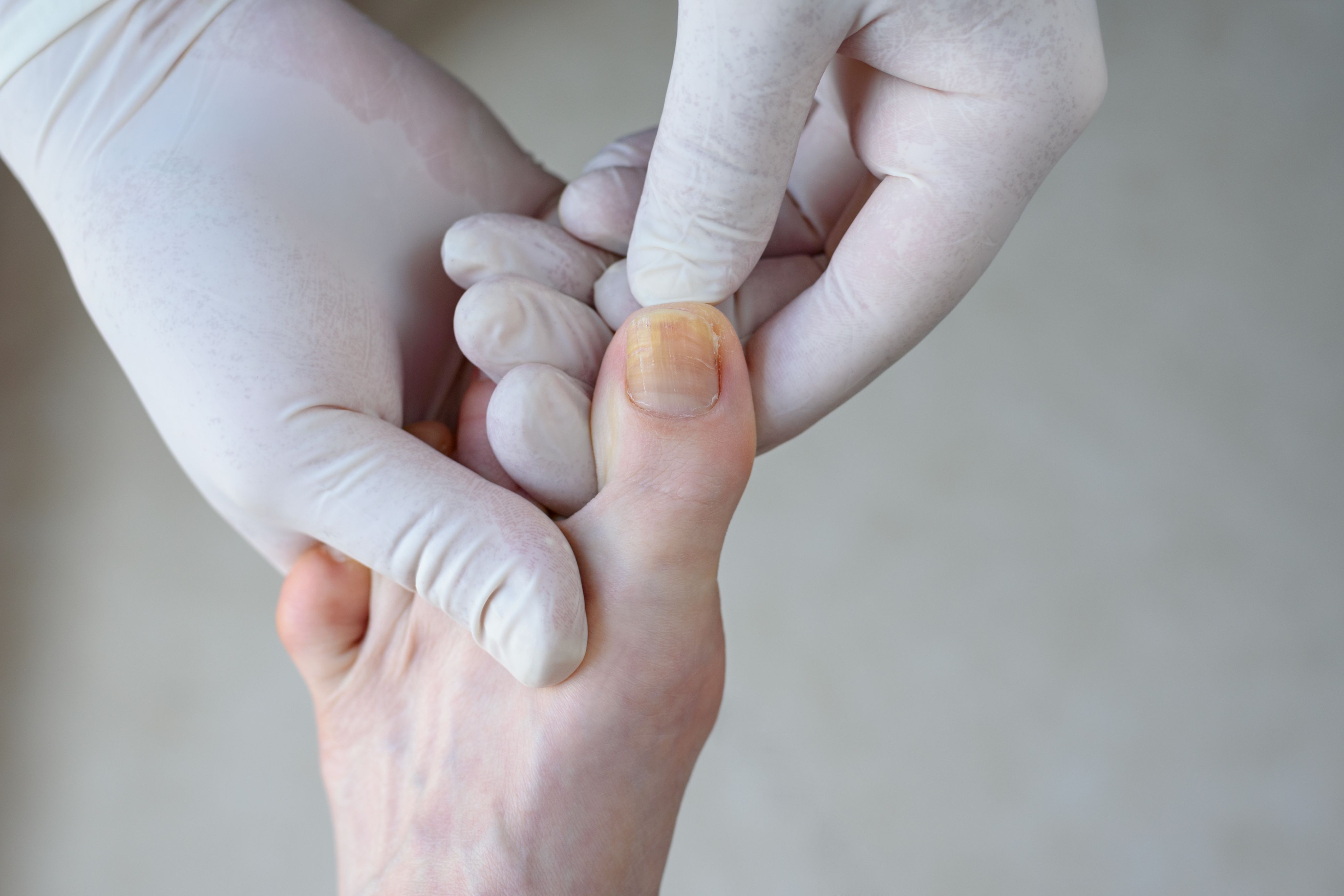 AI Revolutionizes Onychomycosis Diagnosis and Treatment Tracking