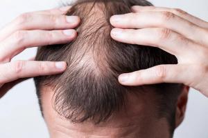 ICYMI: EU Approves Upadacitinib for Severe Alopecia as US Review Remains Pending