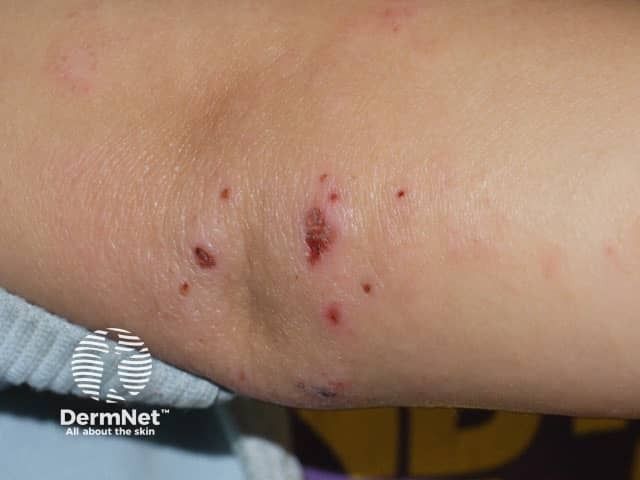 Patient with AD | Image Credit: © DermNet Patient with AD | Image Credit: © DermNet