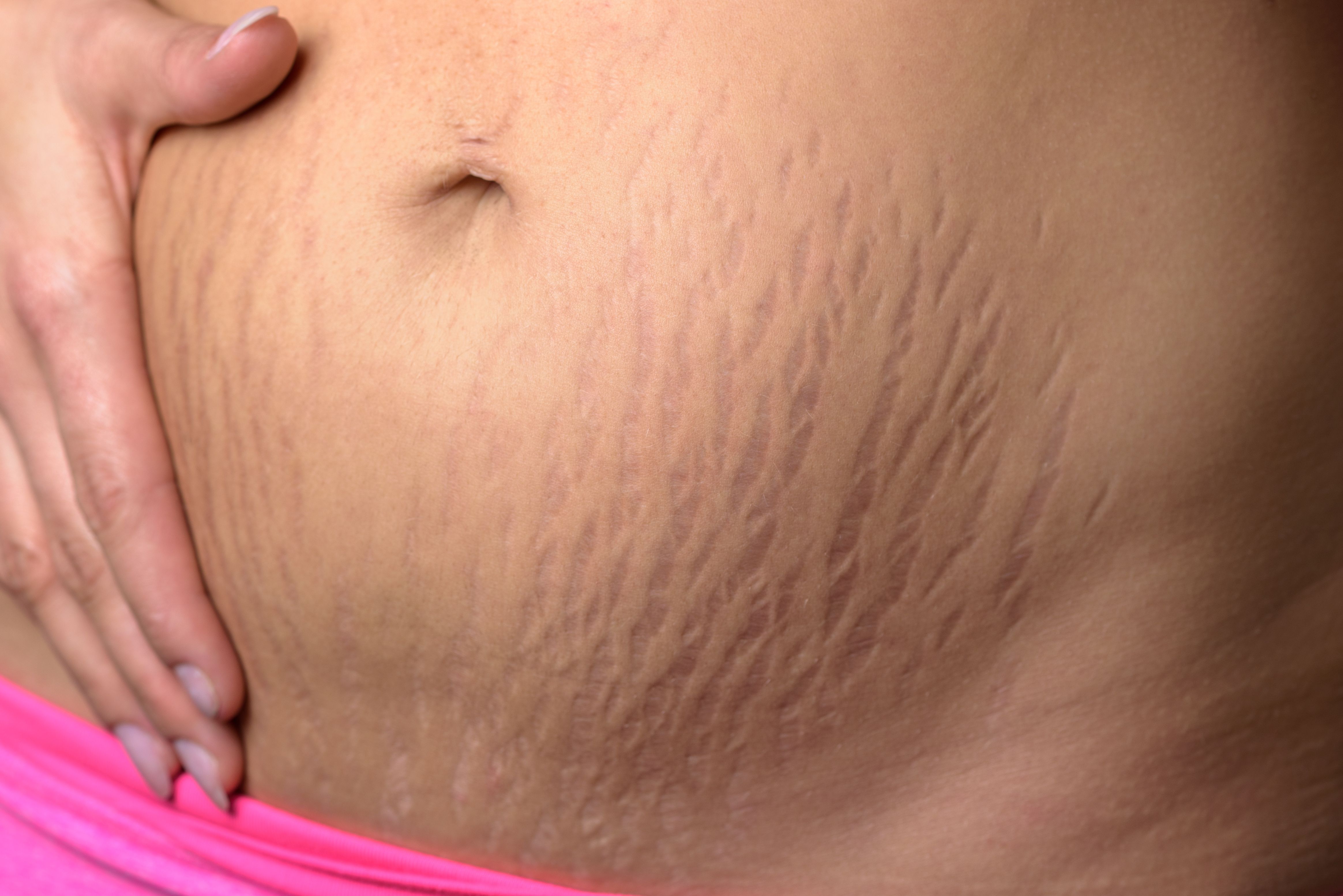 Best Practices for Treating Stretch Marks in Pregnancy
