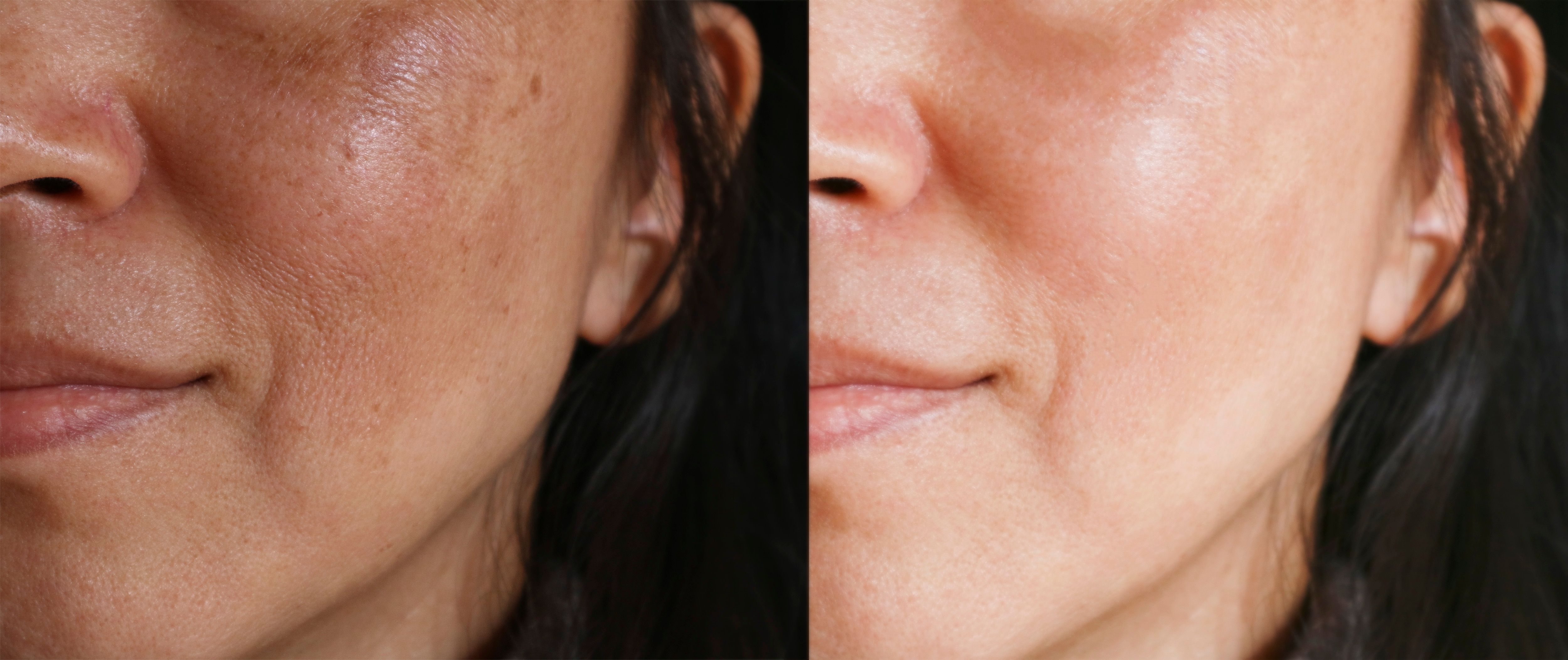 Combination Therapy of RFM and Cysteamine Effective in Treating Melasma