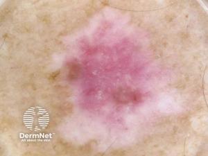 FDA Approves Labcorp's PGDx Elio Tissue Complete CDx for Advanced Melanoma