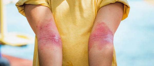 Nemolizumab Maintains Deep Skin and Itch Responses Through 3 Years in Atopic Dermatitis