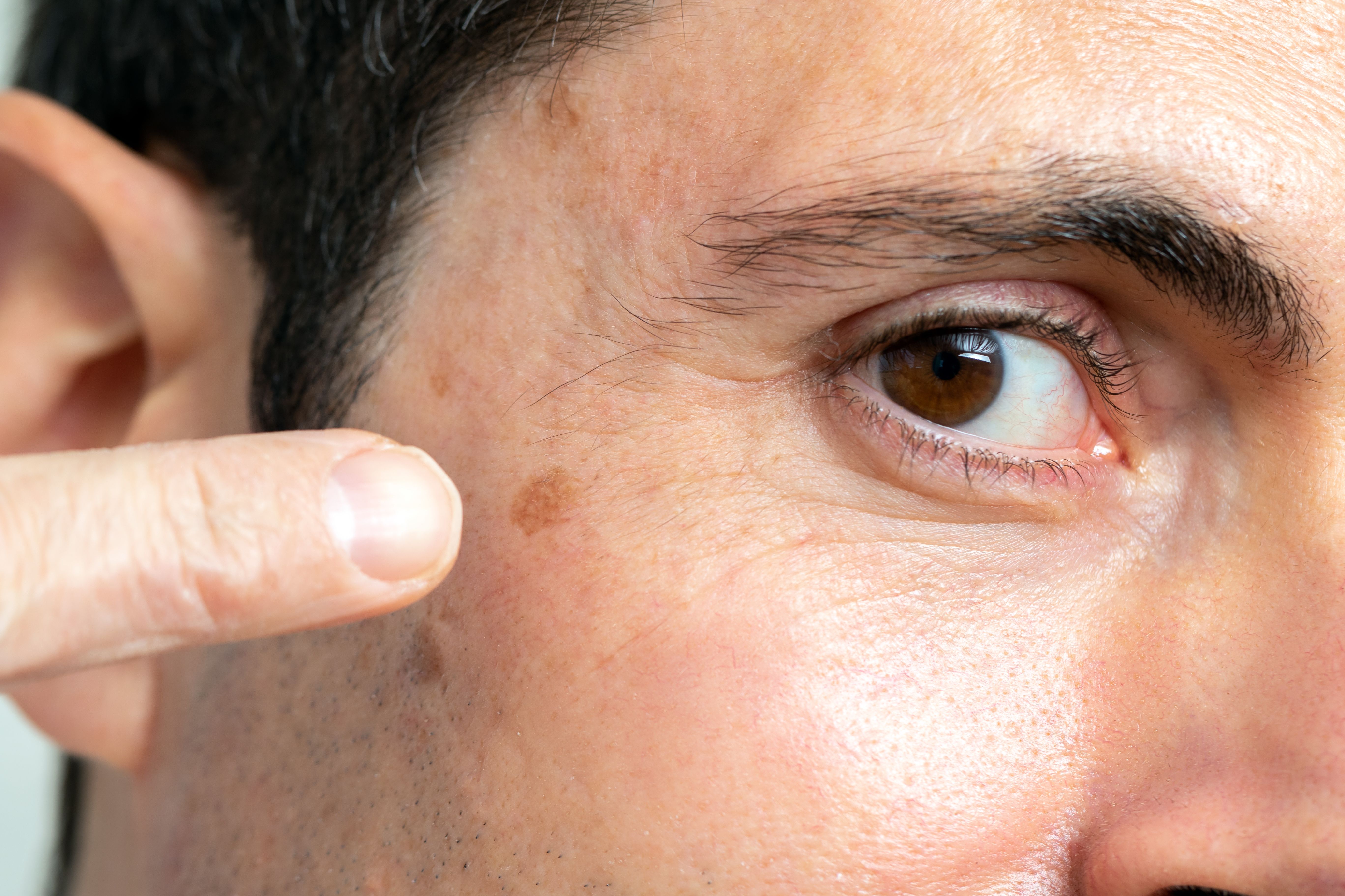 Harnessing the Immune System to Fight Basal Cell Carcinoma: What are the Risks?
