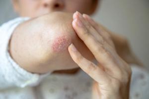 Recognizing Advancements During Psoriasis Awareness Month