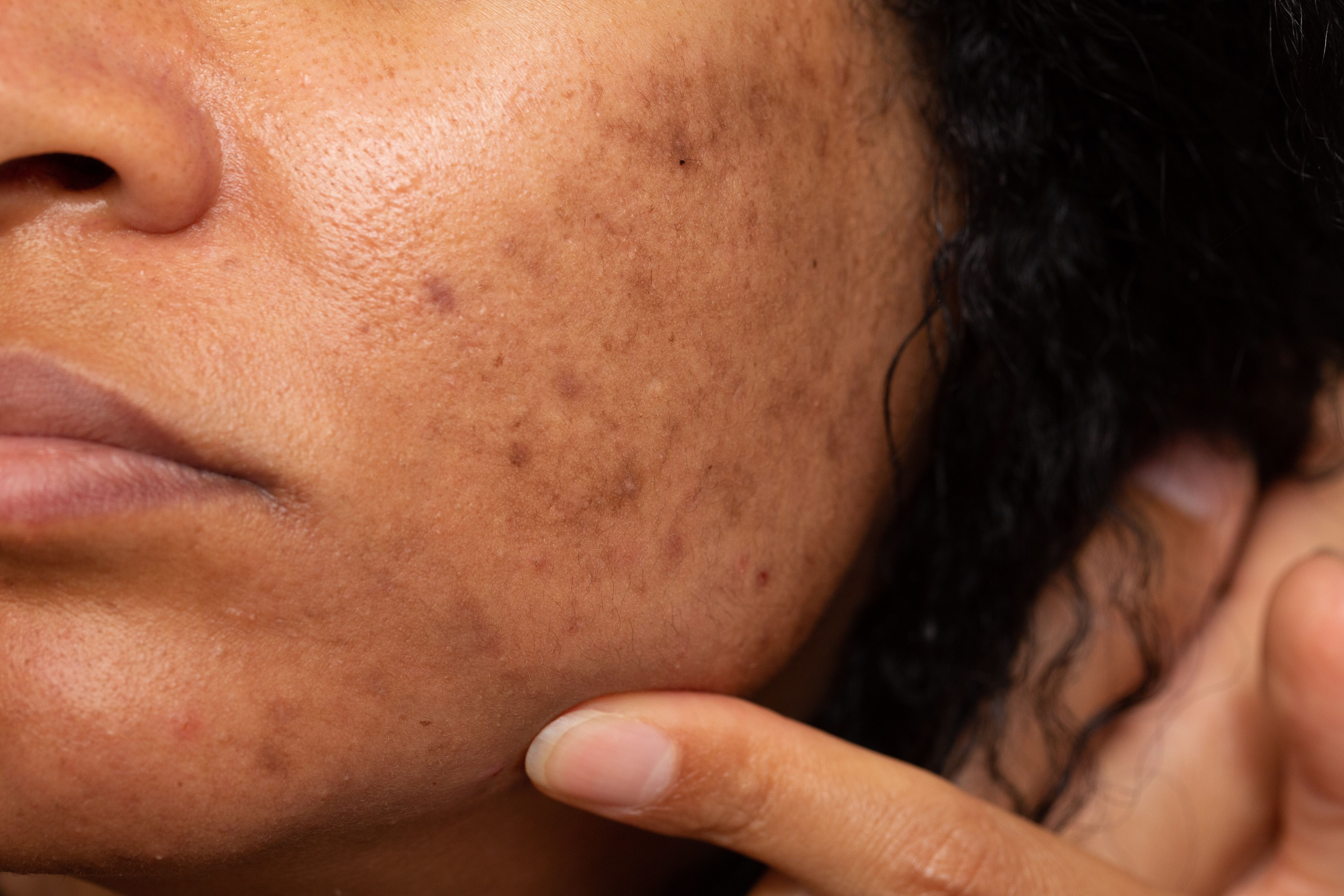 Antioxidant drug promising for melasma