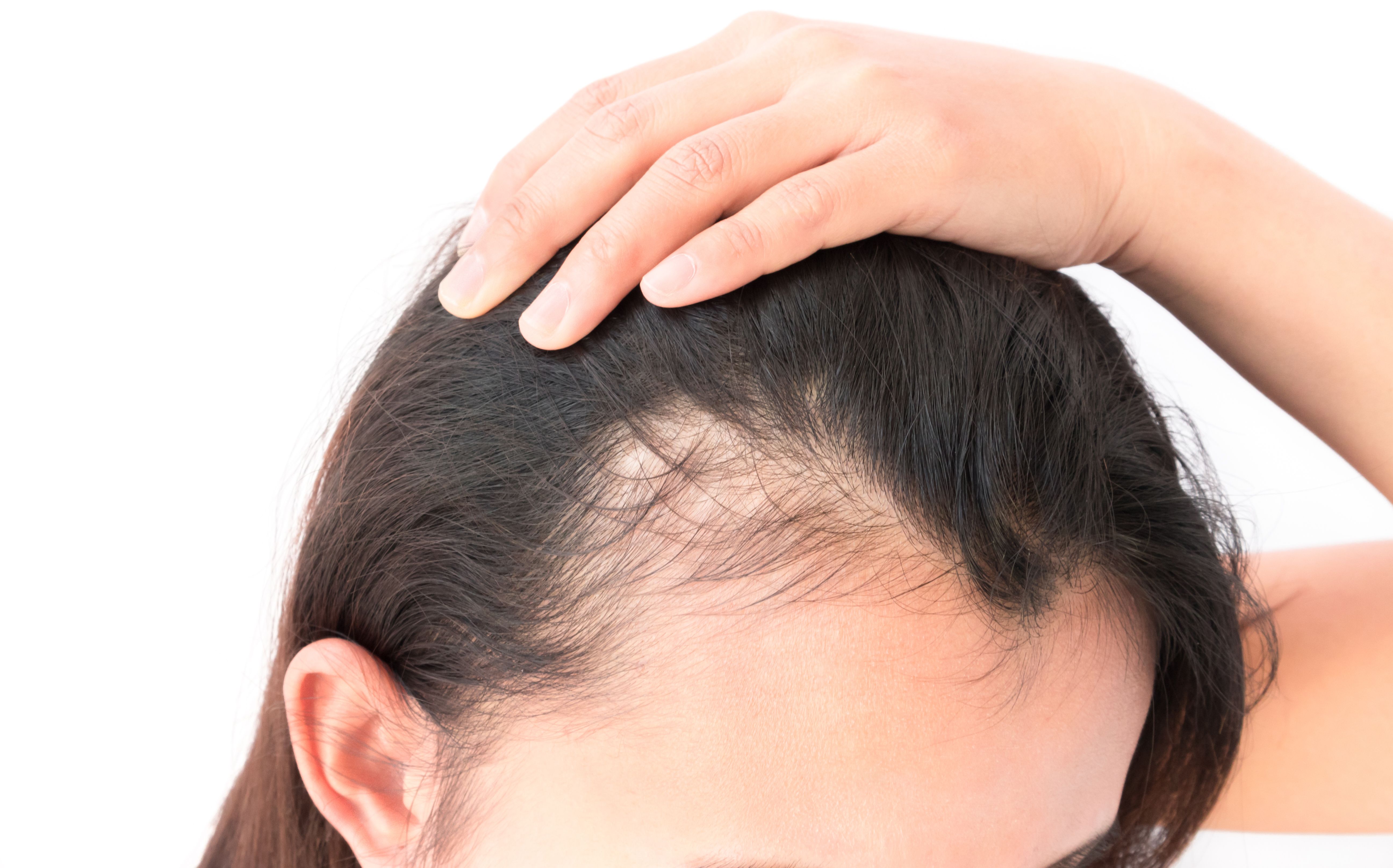 Причину выпадения волос после 40. Экозависимая алопеция. Андрогенетическая алопеция.