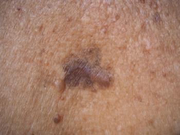 Melanoma