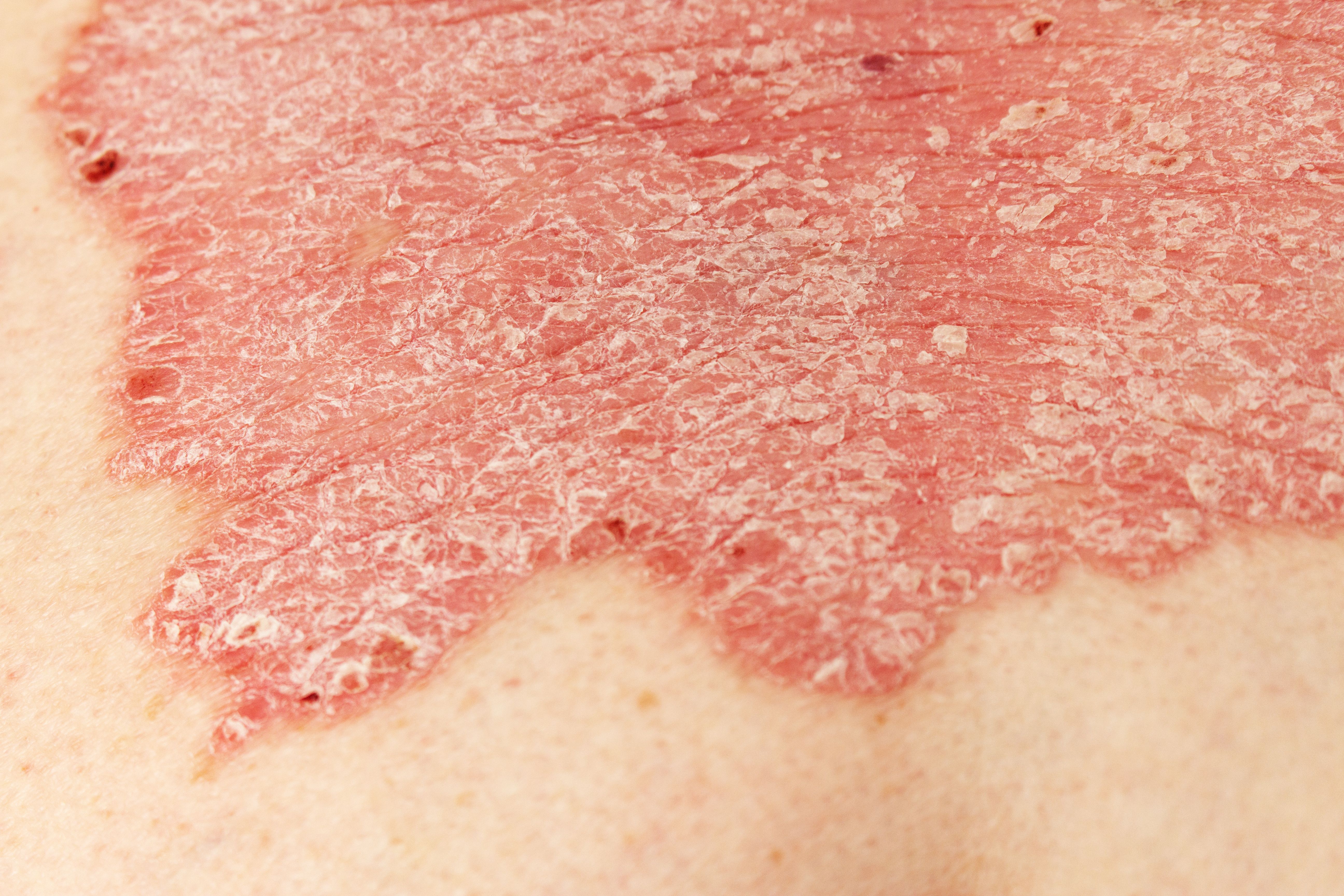 Psoriasis