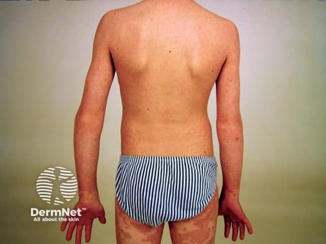 Recognizing the Hidden Burdens of Pediatric Psoriasis
