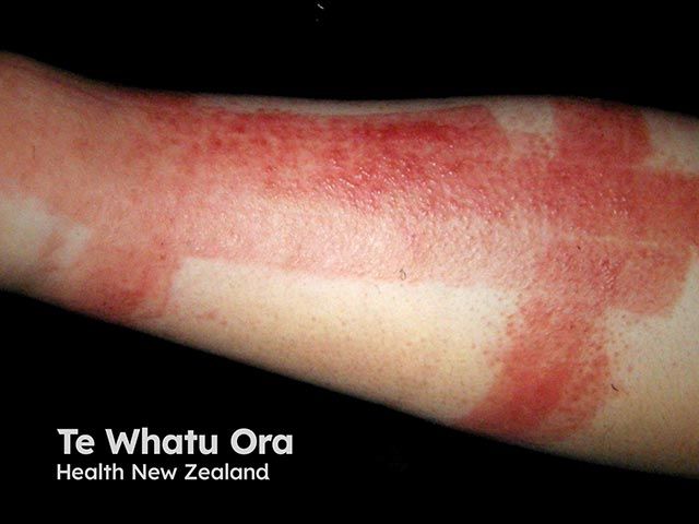 Labor Day Spotlights Hidden Contact Allergens