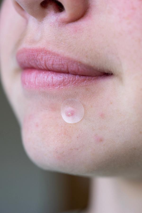 Social Media Mythbusters: Hydrocolloid Pimple Patches