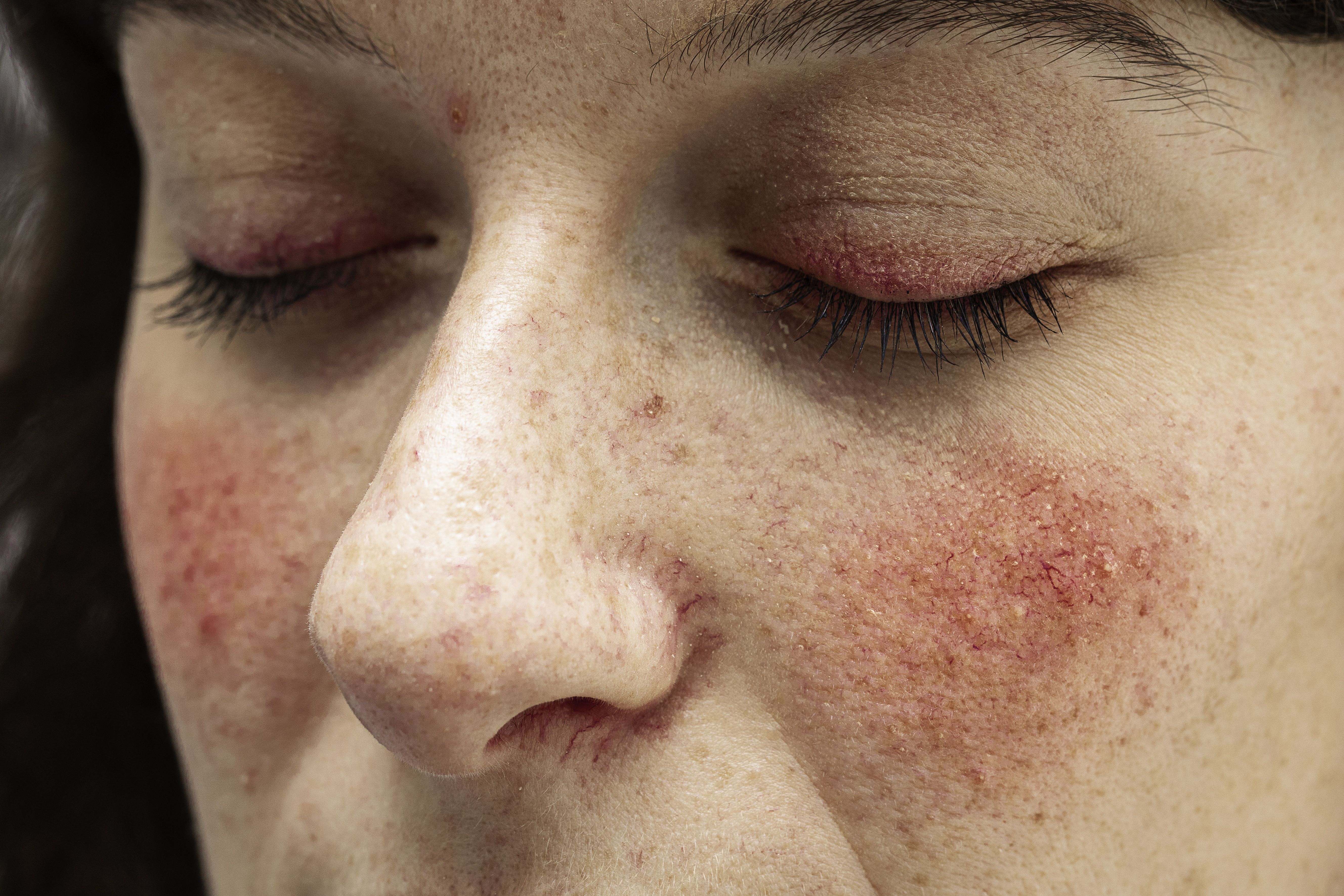 Expert Pearls for Treating Rosacea Patients