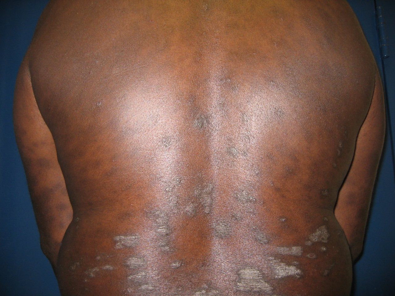 psoriasis skin of color