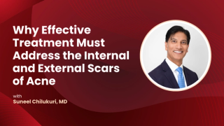 Why Effective Treatment Must Address Both the Internal and External Scars of Acne