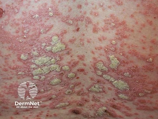 First-in-Class Oral Piclidenoson Reaches Pivotal Phase 3 Enrollment Milestone in Plaque Psoriasis