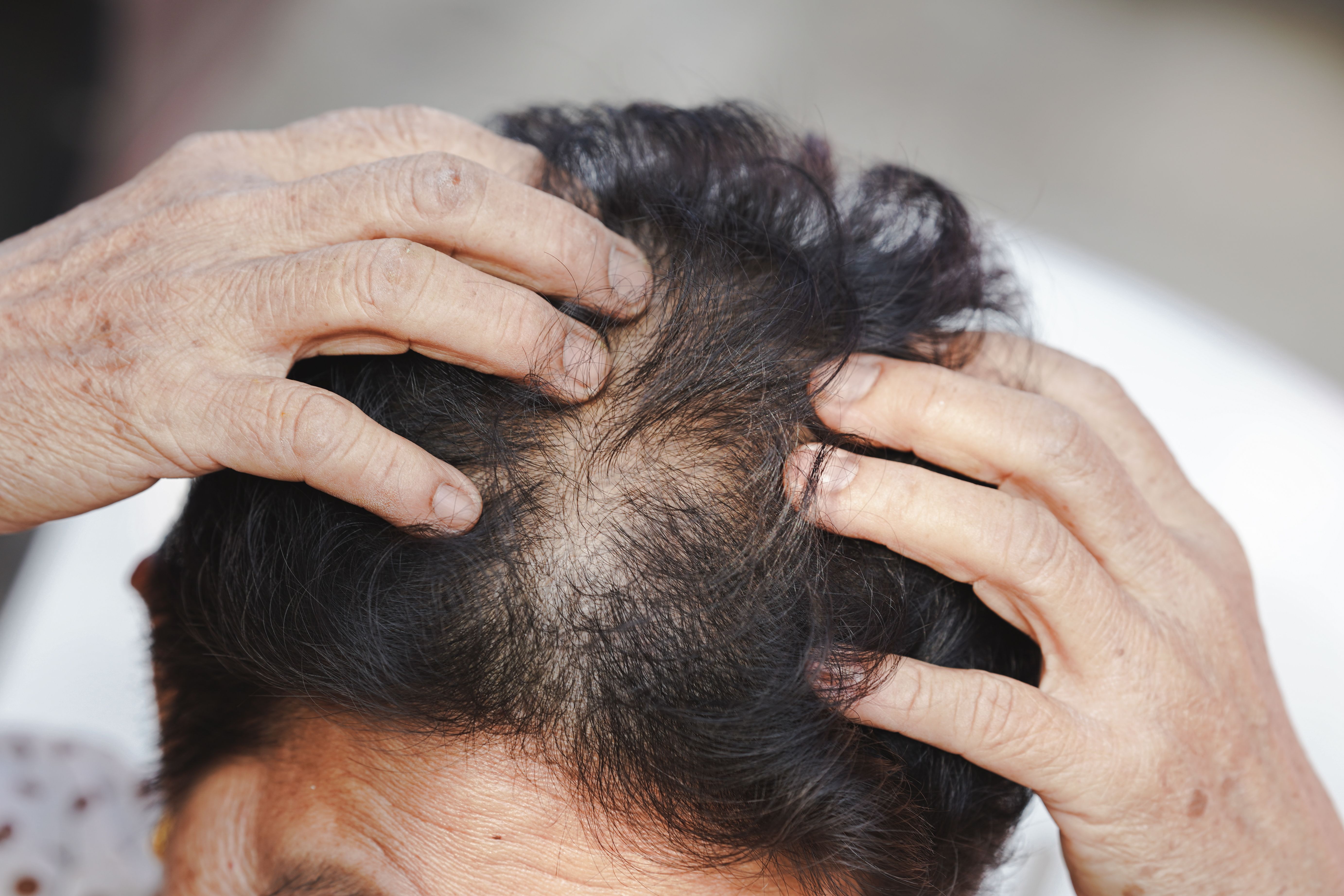 How is hair loss treated? | Life