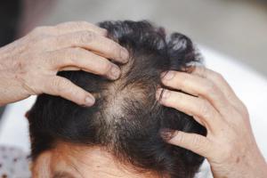 Low-Dose Oral Minoxidil for Hair Growth