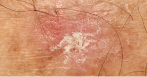 Actinic Keratosis
