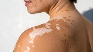 First Patient Dosed in Phase 2 Trial of Topical Pan-JAK Inhibitor LNK01004 for Vitiligo