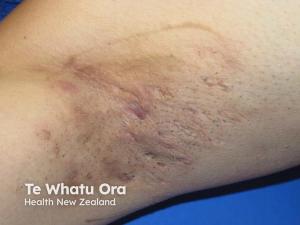 Hidradenitis Suppurativa Claims Data: Sex Parity and Rural Care Gaps