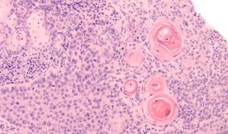 Deep Dive Into High-Risk Cutaneous Squamous Cell Carcinoma