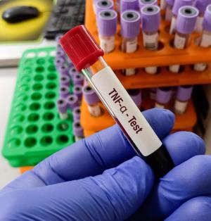 TNF Inhibitors Linked to Increased Skin Cancer Risk in Long-Term Cohort Study